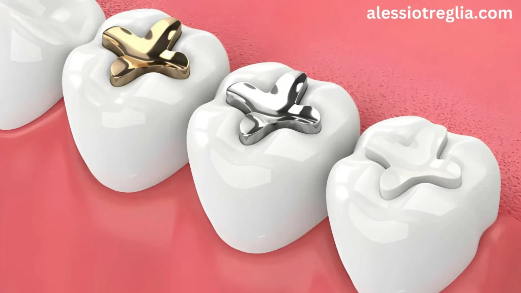 Illustration of dental fillings, including gold and silver fillings. Can you eat after a filling? Understanding the type of filling is key to knowing when it’s safe to eat and what foods to avoid.