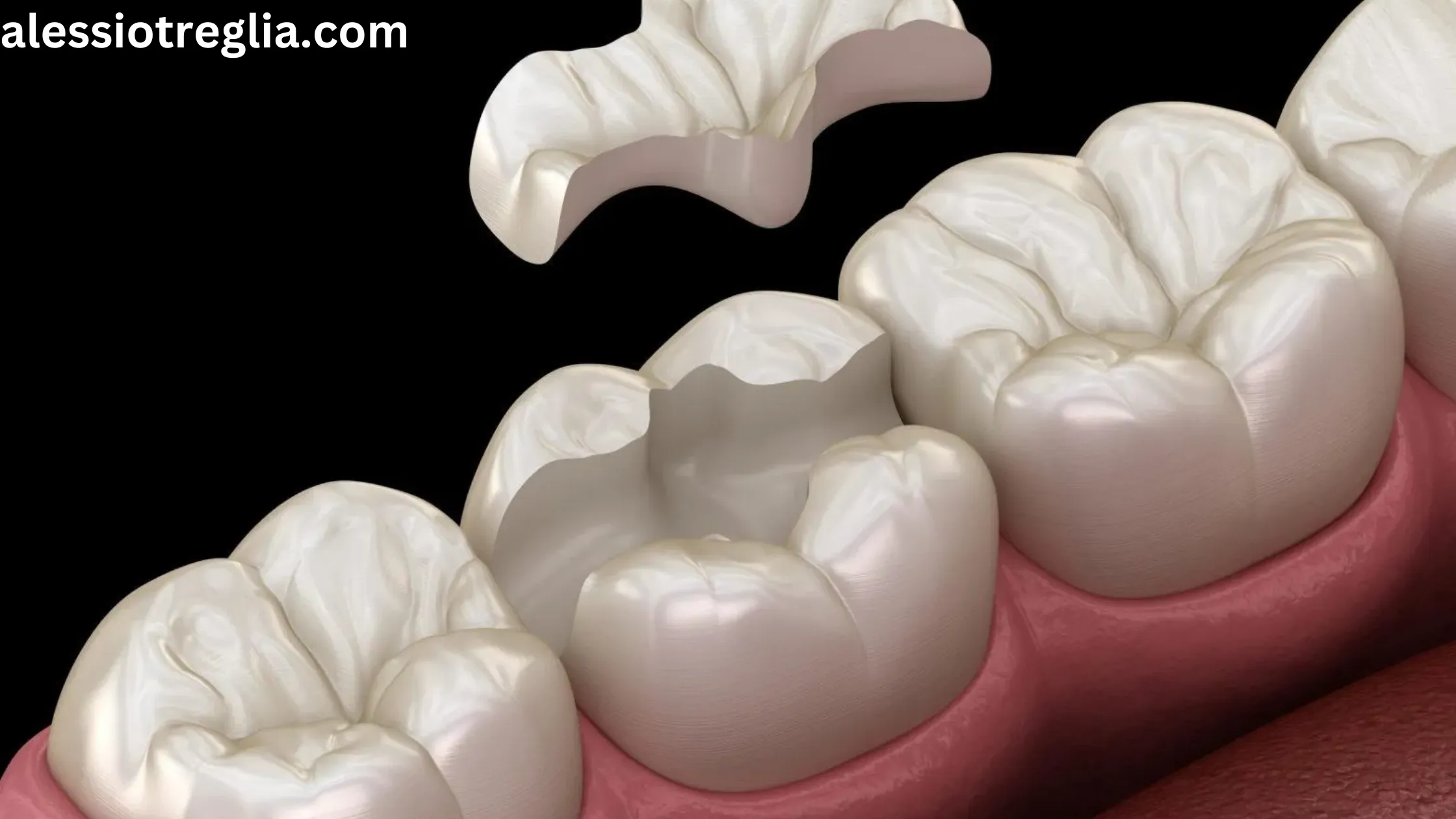 Dental illustration showing a tooth with a filling being placed. Can you eat after a filling? Learn the right care tips to protect your dental work and ensure a quick recovery.